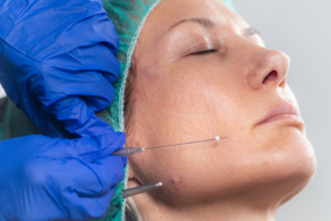 Tratamiento antiedad con hilos bioestimuladores