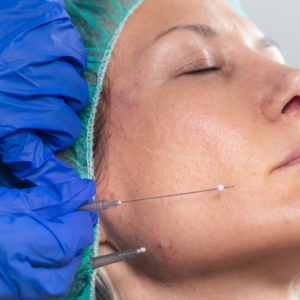 Tratamiento antiedad con hilos bioestimuladores