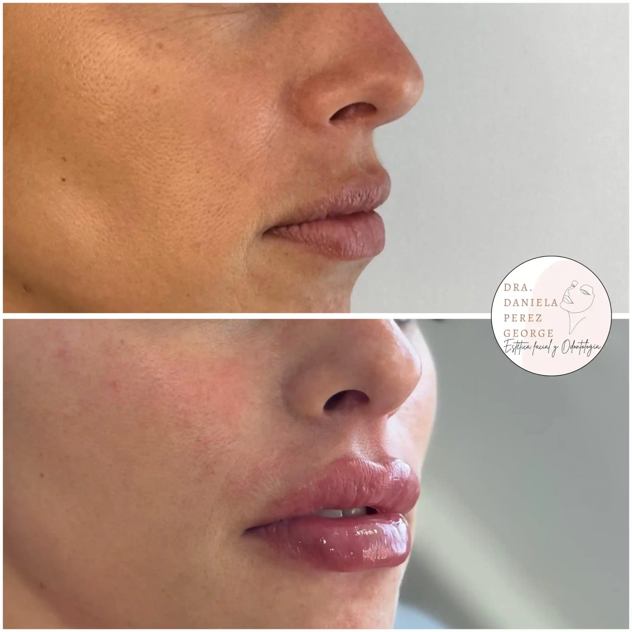 Antes y despues de tratamiento de labios y pink glow con la Dra Perez George