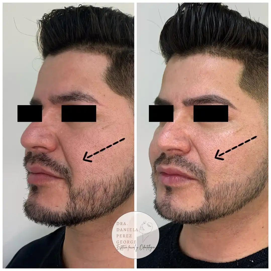 Antes y despues de tratamiento de atenuación de surco nasogenianos con hilos tensores