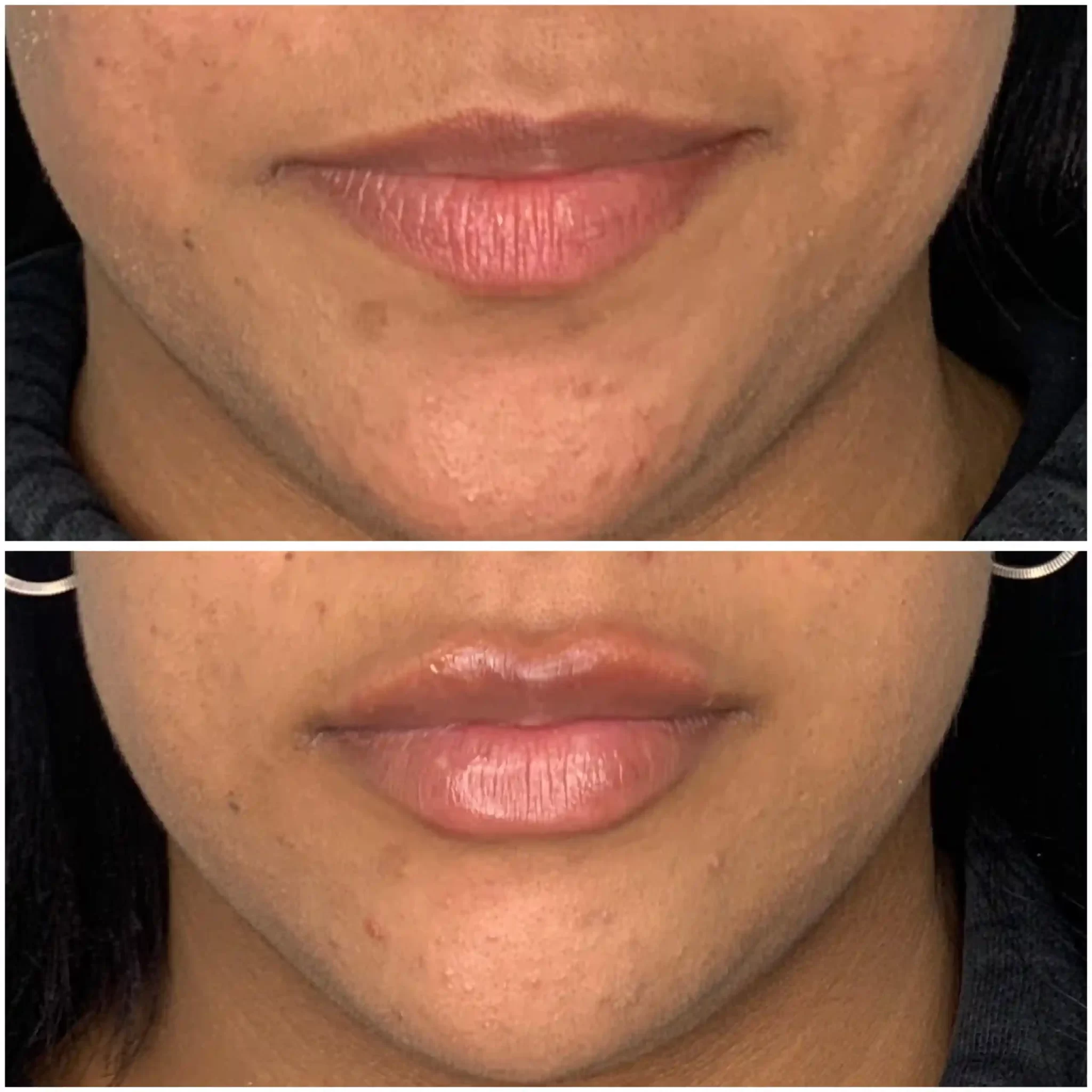 Antes y despues de tratamiento de labios con la Dra Perez George