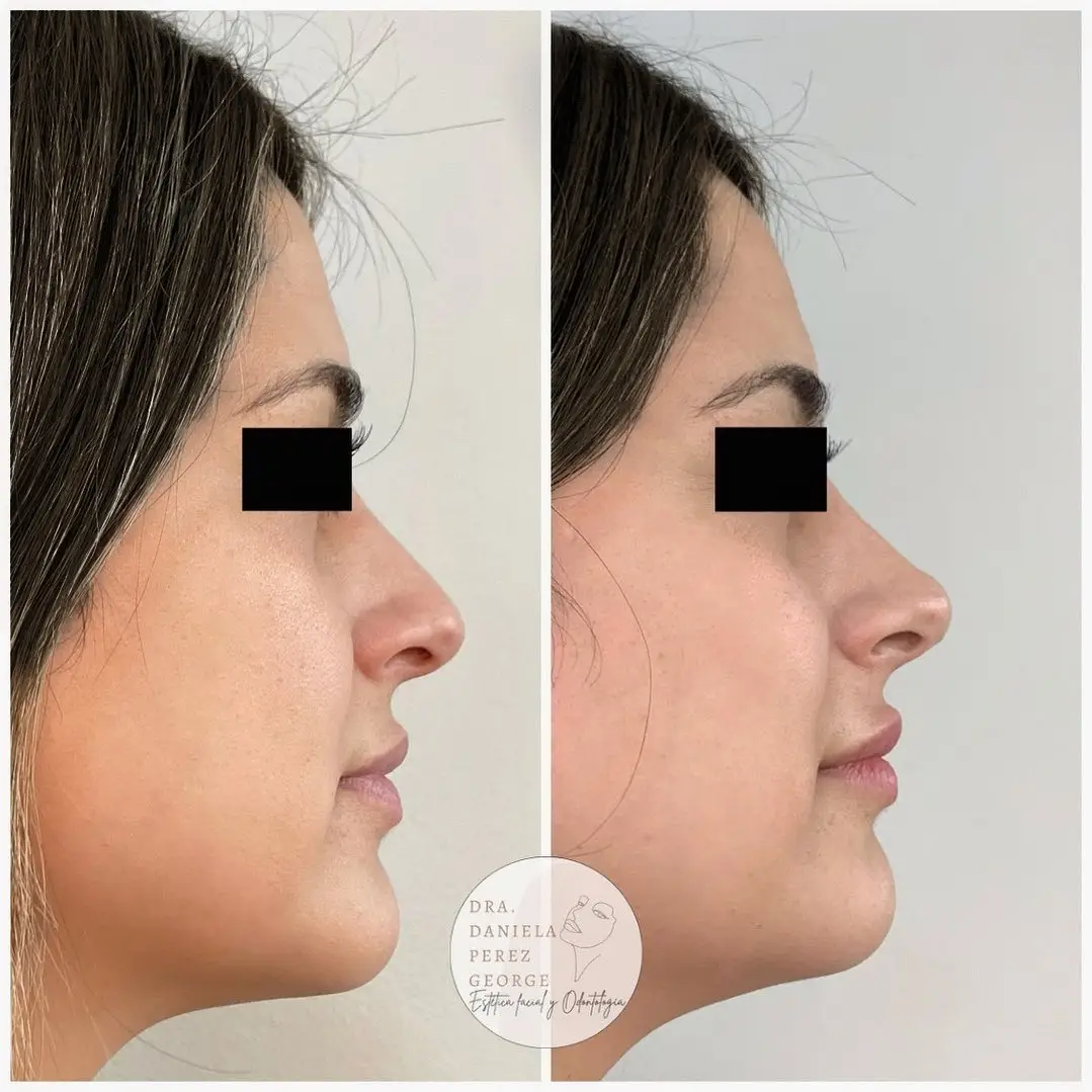 Antes y despues de tratamiento de rinomodelación con ácido hialurónico con la Dra Daniela Perez George